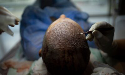 Innovation and Precision: The Engineering Behind Turkey’s Hair Transplant Industry