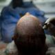 Innovation and Precision: The Engineering Behind Turkey’s Hair Transplant Industry