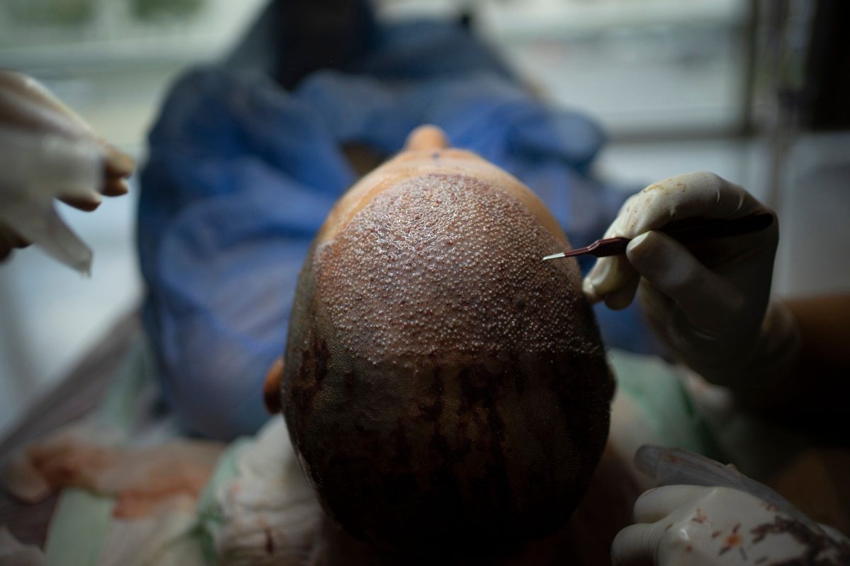 Innovation and Precision: The Engineering Behind Turkey’s Hair Transplant Industry